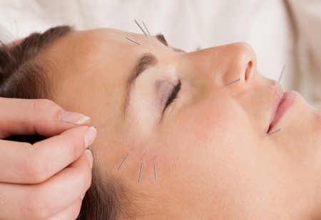 akupunktura kosmetyczna