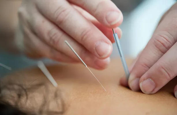 Acupuncture needles being applied to a person's skin during treatment.